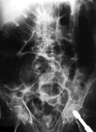 Image result for Adynamic Ileus