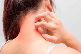 Allergologie Allergien Diagnostik Von Allergenen Heuschnupfen Und Kontaktallergischen Reaktionen Na Schuppenflechte Was Hilft Gegen Juckreiz Dermatologie