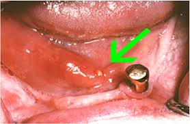 Image result for Sialolithiasis
