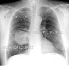Image result for lung cancer xray