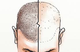 Hair Transplant Timeline What Can You Expect Hairguard