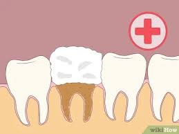 Find out more from webmd. 4 Ways To Prevent Dry Socket After A Tooth Extraction Wikihow