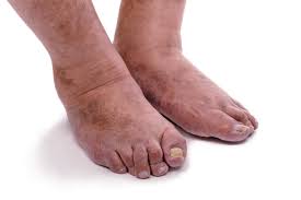 Image result for gout
