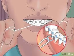 Although flossing with braces can take practice, fry orthodontic specialists recommend using a threader to help make the process quick and convenient for you. 3 Ways To Be Happy With Braces Wikihow