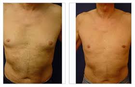 Secondary breast cancer in the liver. Gynecomastia Is The Primary Male Breast Surgery Cpsi