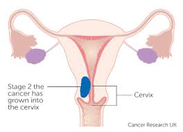 10 years later i am cancer free but know that i there is an army of survivors out there with similar stories. Stage 2 Womb Cancer Cancer Research Uk