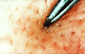 Ingrown hairs on the legs are a common problem for people who shave or wax the area. Ingrown Hair Removal How To Get Rid Of Ingrown Hairs Men S Health