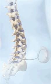 Image result for Intrathecal Pump