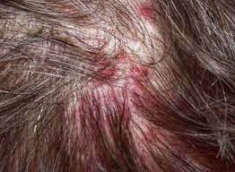 One common cause of itchy scalp is seborrheic dermatitis, a skin condition that causes your scalp to break out into scaly, red patches and can lead to dandruff. Red Itchy Bumps On Scalp Sores On Scalp Scalp Scabs Pimples On Scalp