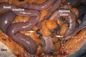 Image result for Diverticulitis
