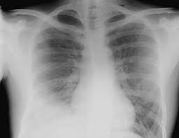Here's why cancer can look like an infection: Parasitic Infections Of The Lung A Guide For The Respiratory Physician Thorax