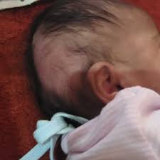 When does baby hair loss occur? Hello Doctor My 2 Months Old Baby Has Hair Loss And Bald Scalp Both Right Side And Left Side While Feeding Her I Hold Her Head With Baby Wrap That Is