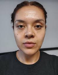 Lower blepharoplasty and fat transfer : r/PlasticSurgery