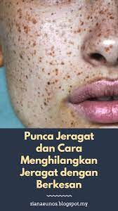 Cara alami menghilangkan jerawat ini bisa termasuk menggunakan gel, minyak esensial. Punca Jeragat Dan Cara Menghilangkan Jeragat Dengan Berkesan Ziana Eunos