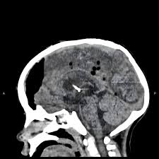 Image result for Pallidotomy