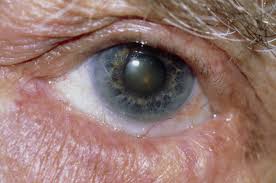 When it is flipped out after an insect (fig. Entropion And Ectropion Eye Disorders Merck Manuals Consumer Version