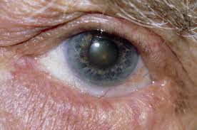 Eyelid flip these pictures of this page are about:flipped eyelids. Entropion And Ectropion Eye Disorders Merck Manuals Consumer Version