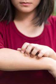 Washing hands with soap and water is the best way to get rid of germs in most situations. How Long Is Ringworm Contagious What To Know