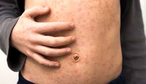 Measles virus