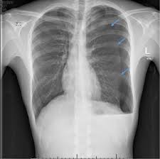 Image result for Pneumothorax