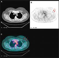 It has all the features and applications which comes out of the box with google pixel smartphone. A Comparative Study On The Value Of Fdg Pet And Sentinel Node Biopsy To Identify Occult Axillary Metastases Annals Of Oncology