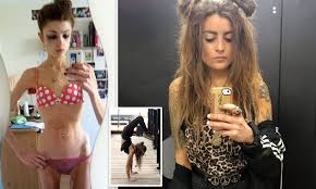 Anorexic vegan, 27, who weighed just five stone makes a full recovery  thanks to yoga | Daily Mail Online