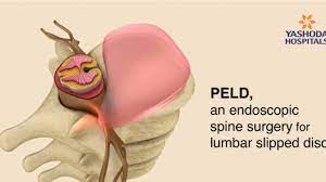 We did not find results for: How To Diagnose And Treat Herniated Disc Peld