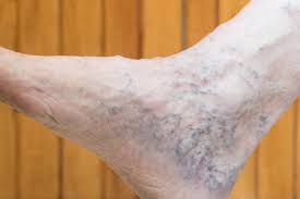 Complications can include bleeding or superficial thrombophlebitis. Are Varicose Veins Dangerous Vascular Solutions Vein Specialists
