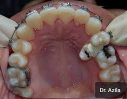 Ini adalah beberapa jenis braces yang ada di pasaran. Pakai Braces Lebih Tiga Tahun Sudahnya Bengkak Muka Gigi Rosak Teruk Mingguan Wanita