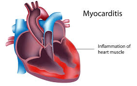 Kumar et al, robbins and cotran pathologic basis of disease. Pin On Heart Failure