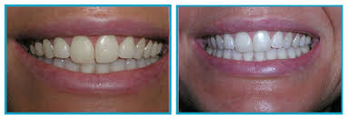 For others, it might take a few days longer to start seeing results. Teeth Whitening In Scarsdale Ny Scarsdale Dental Group