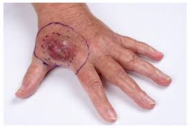 Image result for Merkel Cell Carcinoma