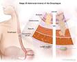 Image result for esophageal cancer silkworm