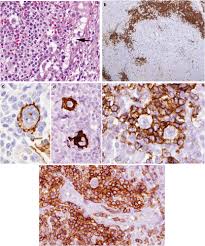 Angioimmunoblastic — an·gio·im·mu·no·blas·tic (an″je o im″u no blasґtik) characterized by the presence of immunoblasts (lymphoblasts) and an inflammatory infiltrate in small blood vessels. Angioimmunoblastic T Cell Lymphoma With Hodgkin Reed Sternberg Like Download Scientific Diagram