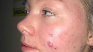 Cinco Coisas Que Nao Se Deve Dizer Para Quem Tem Acne Bbc News Brasil