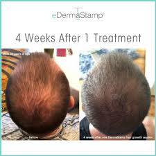 When you roll the derma roller on your scalp, its needles puncture holes so that the remedial qualities of oils can easily reach the hair follicles. Dermaroller Posts Facebook