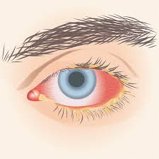Image result for Bacterial Conjunctivitis