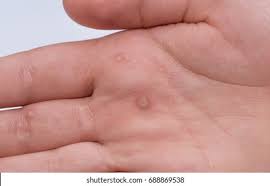 Image result for verrucae filiformes