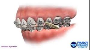 Check spelling or type a new query. How To Fix An Overbite With Braces Overbite Braces Fix Overbite