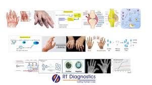 Image result for Rheumatoid Factor
