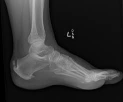 Haglund's deformity occurs when irritation to the heel bone causes it to grow a protrusion. Haglund Deformity Radiology Case Radiopaedia Org