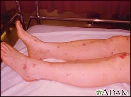 Acute infectious pf occurs most commonly in the setting of meningococcemia due to elaboration of endotoxin. Meningococcemia Associated Purpura Medlineplus Medical Encyclopedia Image