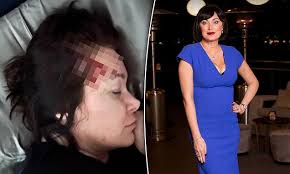 Real Housewives of Sydney star Lisa Oldfield reveals shock image of  battered and bloodied head