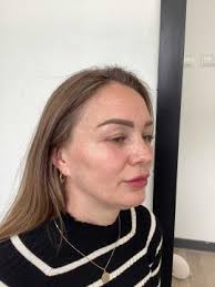 Cheekbone fillers from £155