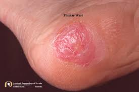Plantar warts caused by human papilloma virus (hpv)may be challenging to treat when conventionalmodalities fail. Anatomy Of A Plantar Wart