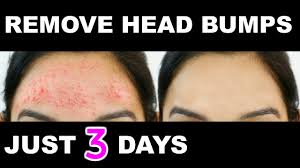 It's recommended to consult a trichologist and treat dandruff before it results in skin problems. How To Get Rid Of Small Pimples Head Bumps Fast Naturally Anaysa Youtube