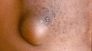 Was Tun Gegen Lipome Swr Wissen