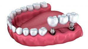 In toate listele de preturi vei gasi pretul pentru un implant dentar si nu pretul pentru tratamentul cu implant dentar. Implant Dentar Intrebari Si Raspunsuri Preturi Implanturi Mdlpl