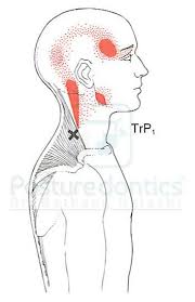 Myofascial trigger point reference including referred pain and muscle diagrams as well as symptoms caused by triggerpoints. How To Treat Pain Caused By Trigger Points Dental Products Report