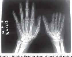 Poland syndrome is a rare, congenital defect that is characterized by: Figure 2 From Poland S Syndrome With Unusual Hand And Chest Anomalies A Rare Case Report Semantic Scholar